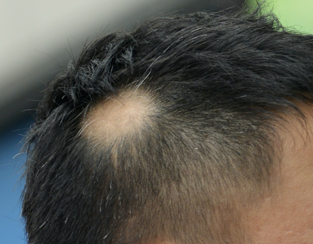 薄毛の対処法｜円形脱毛症を治す5つの方法